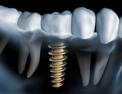 imagen de un implante dental